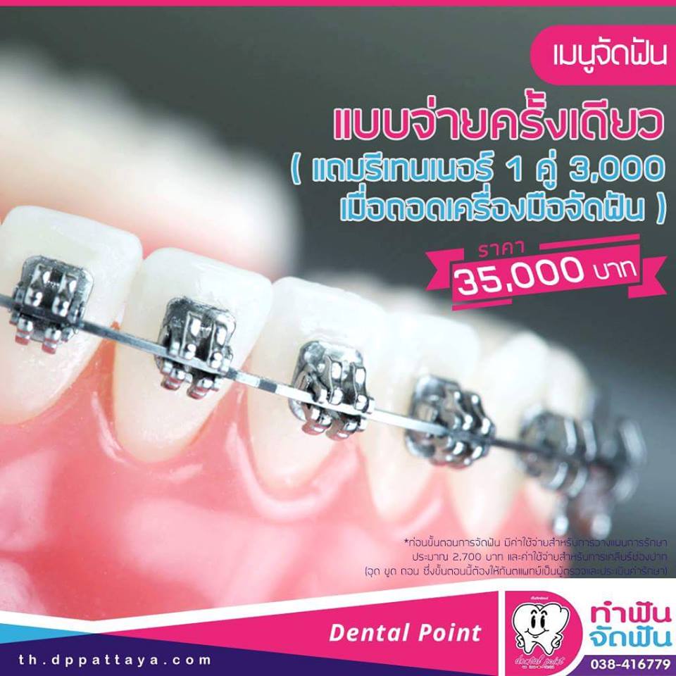 จัดฟันราคา