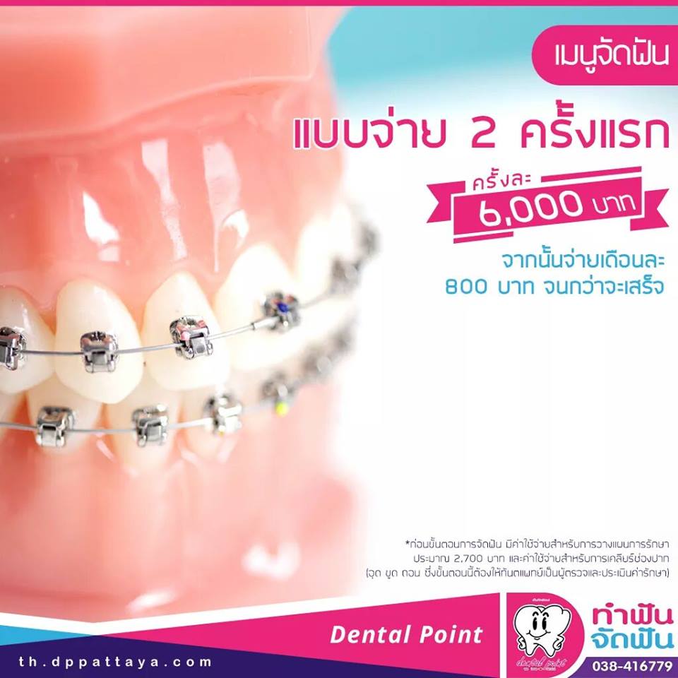 จัดฟันราคา