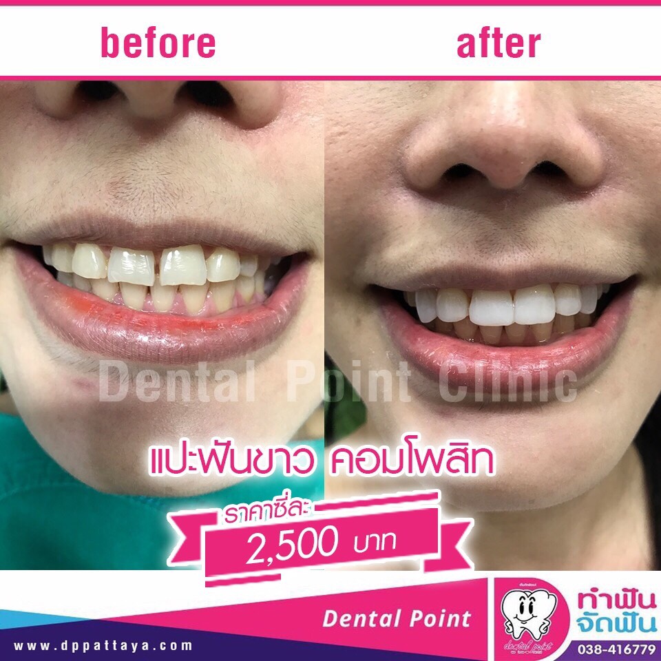 คอนโพสิทวีเนียร์ (Composite veneer)