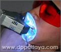 18.การฉายแสง Cool Light.