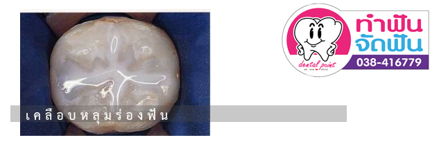 เคลือบหลุมร่องฟันสำหรับเด็ก