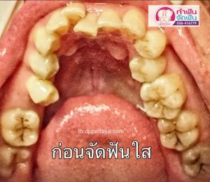 ก่อนใส
