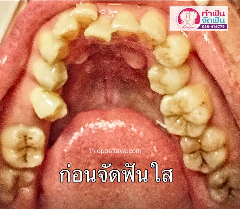 ก่อนจัดฟันใส