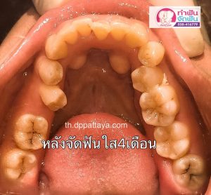 หลังใส