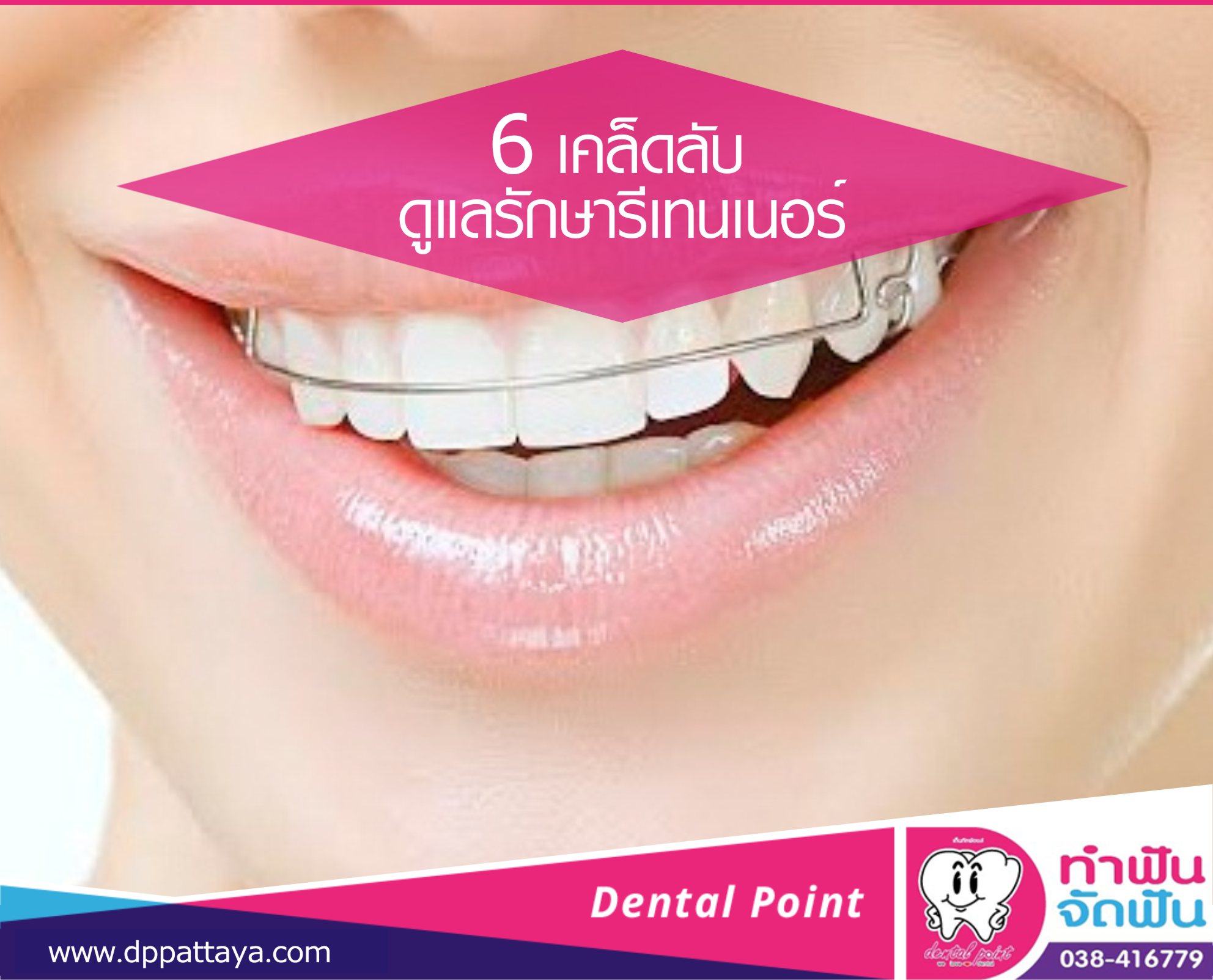 6 เคล็ดลับดูแลรักษารีเทนเนอร์