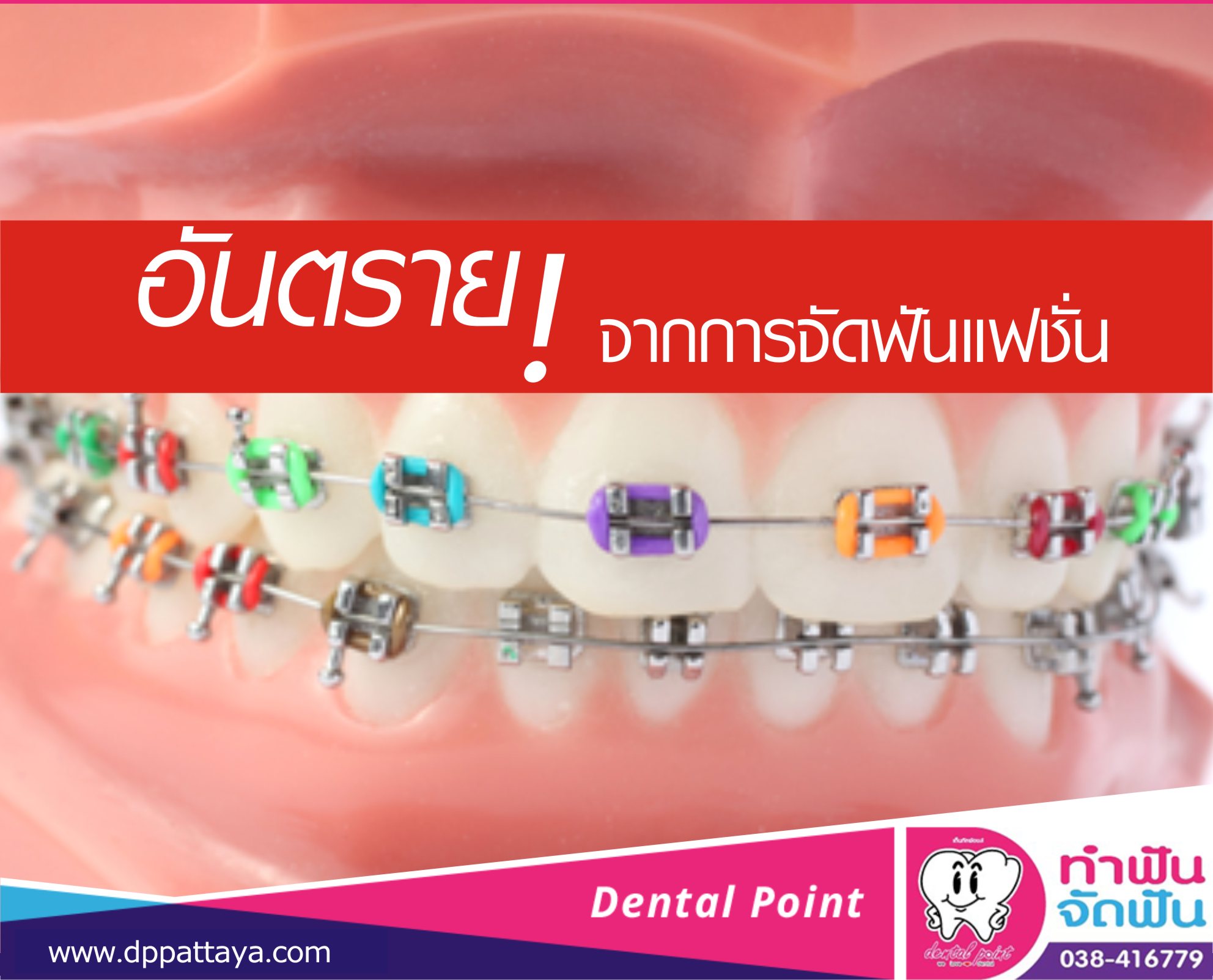 อันตรายจากการจัดฟันแฟชั่น