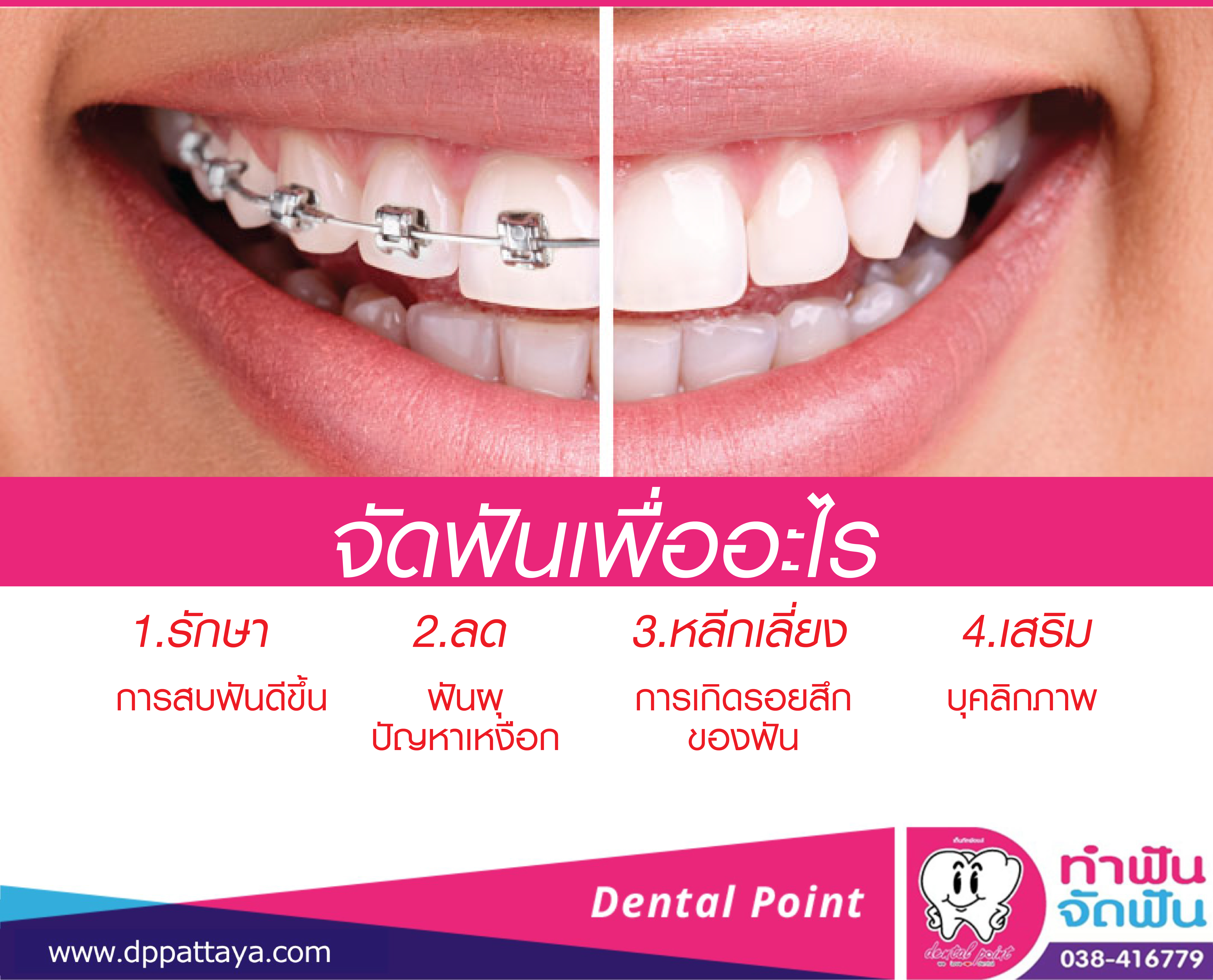 ข้อดีของการจัดฟันดามอน