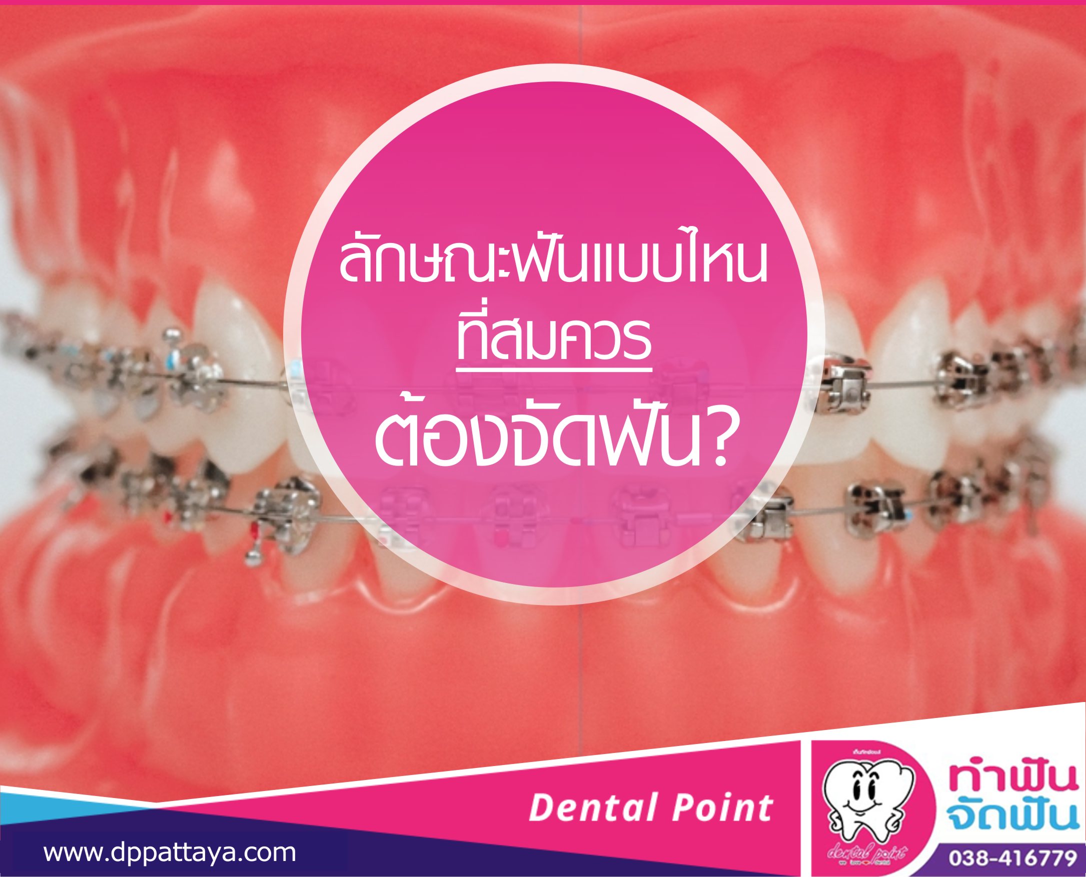 ลักษณะฟันแบบไหนที่สมควรต้องจัดฟัน?