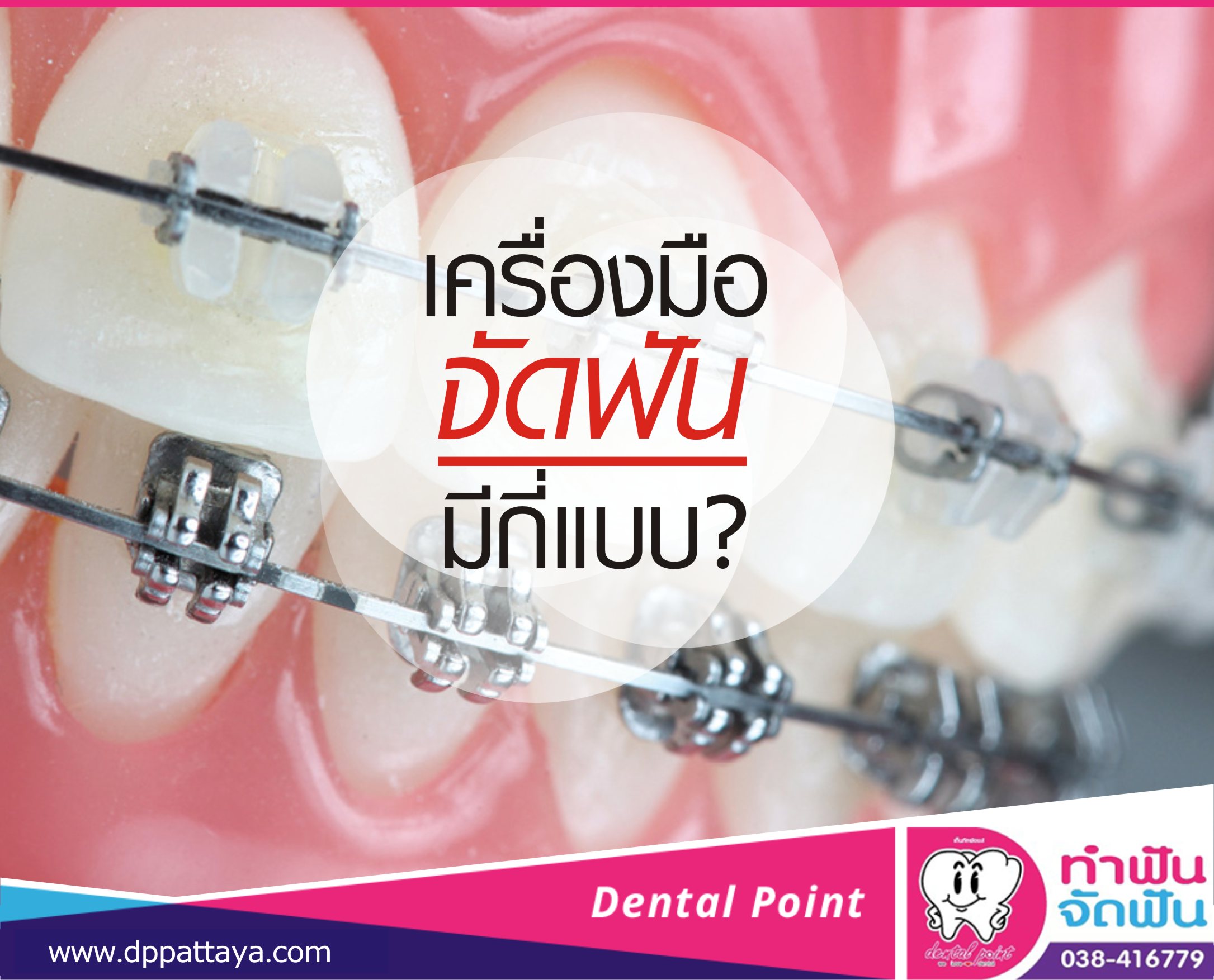 เครื่องมือจัดฟัน มีกี่แบบ ?