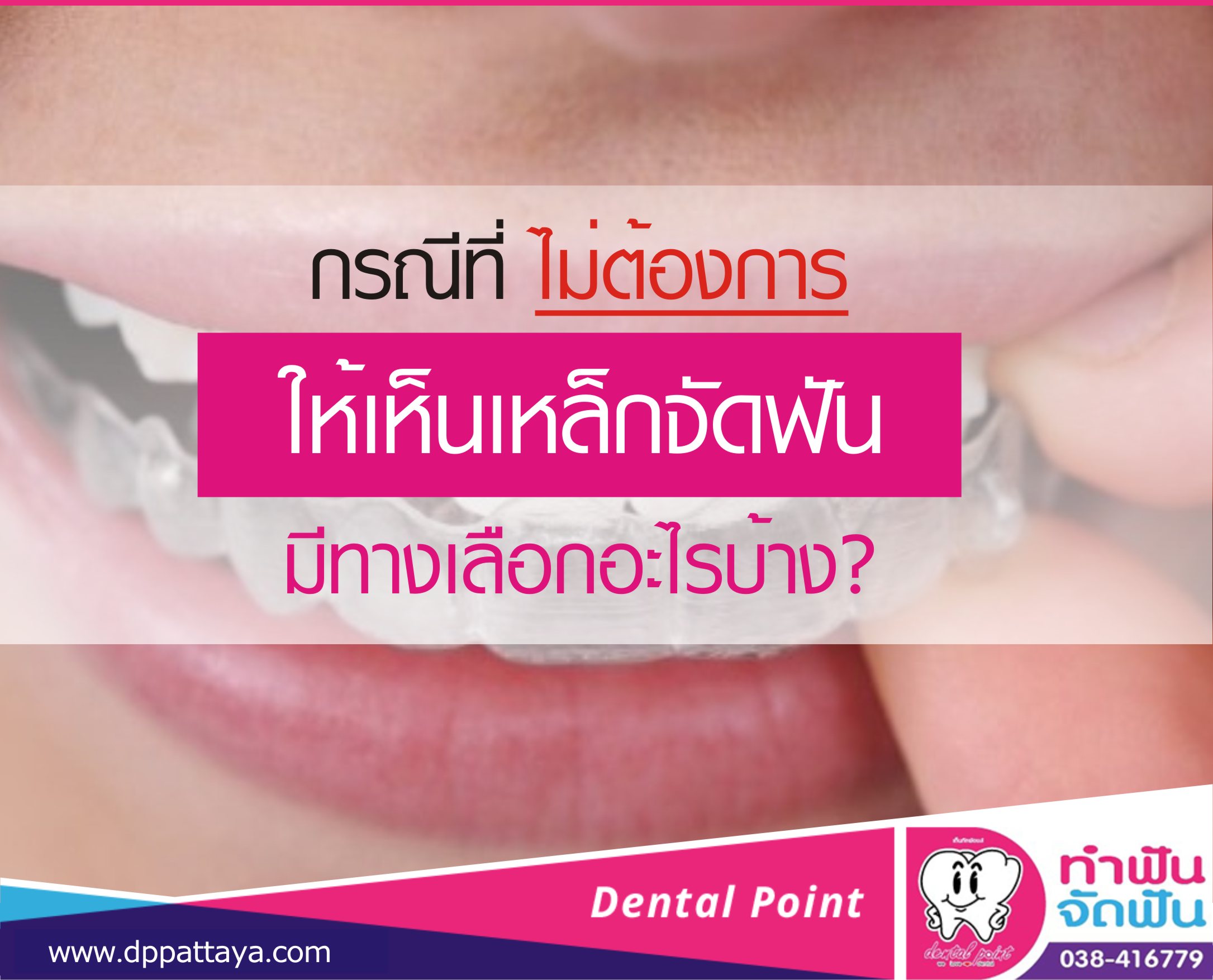กรณีที่ไม่ต้องการให้เห็นเหล็กจัดฟันมีทางเลือกอะไรบ้าง?