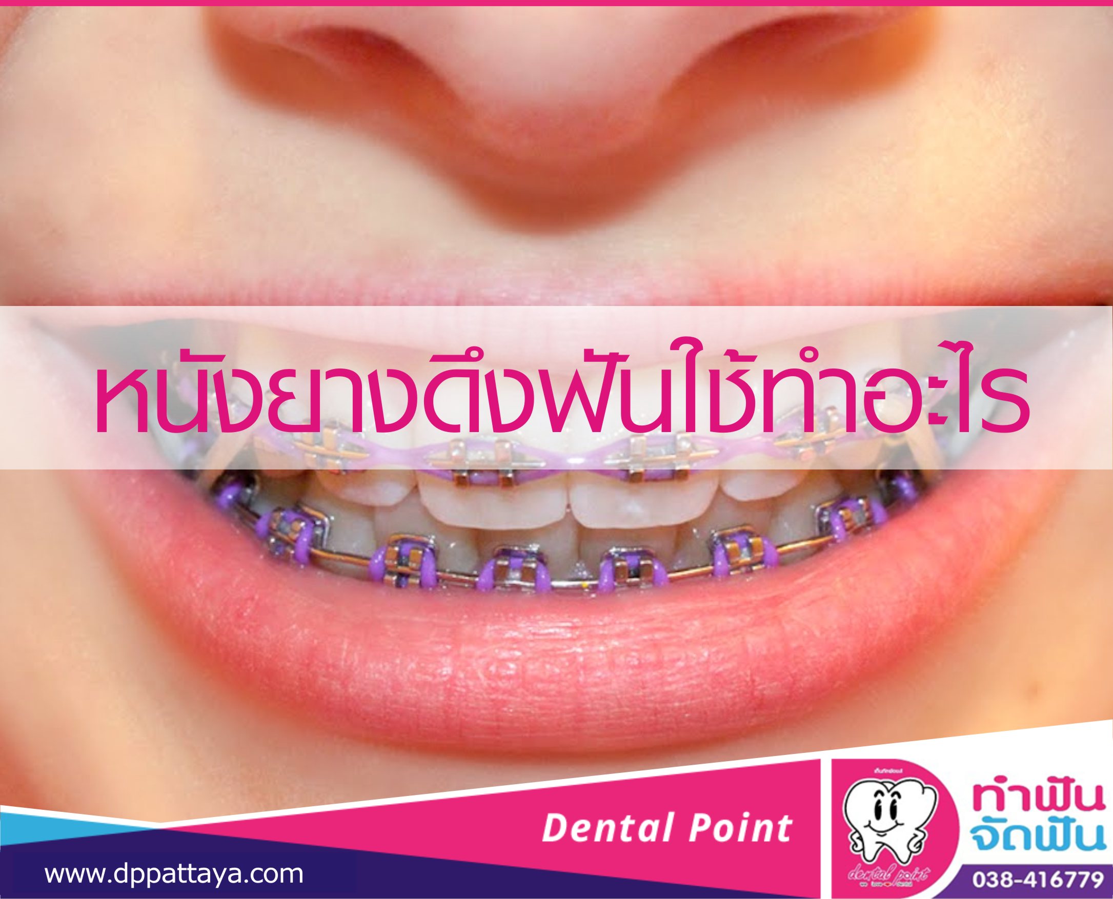 หนังยางดึงฟันใช้ทำอะไร