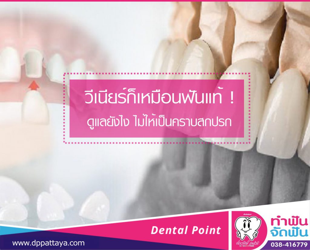 ดูแลวีเนียร์ ให้เหมือนฟันแท้ของเรา