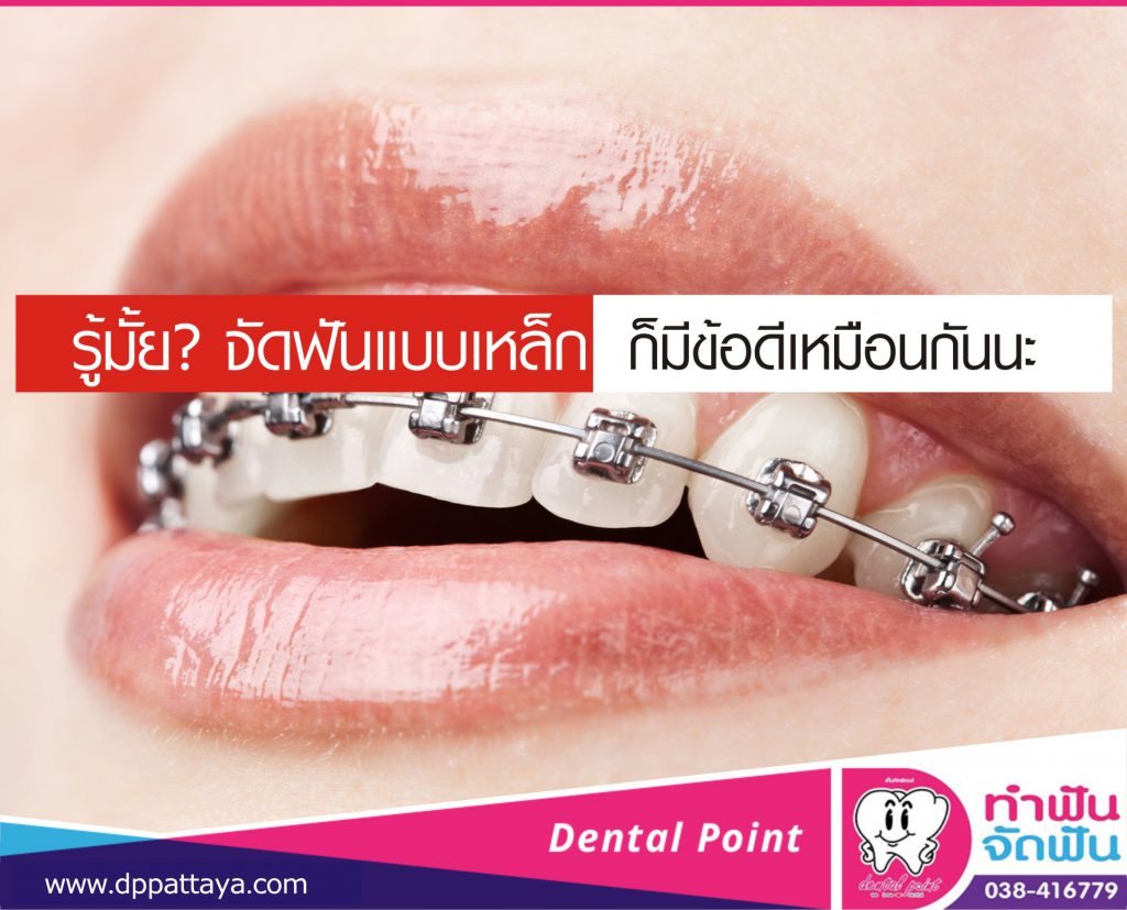 ข้อดีของการจัดฟันเหล็ก