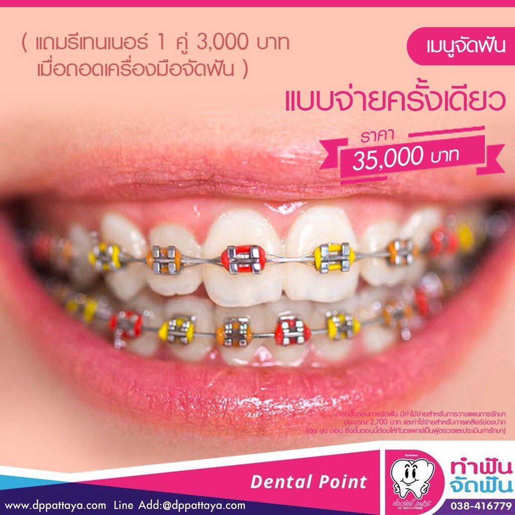 เมนูจัดฟัน จ่ายครั้งเดียว จัดฟันเหล็ก