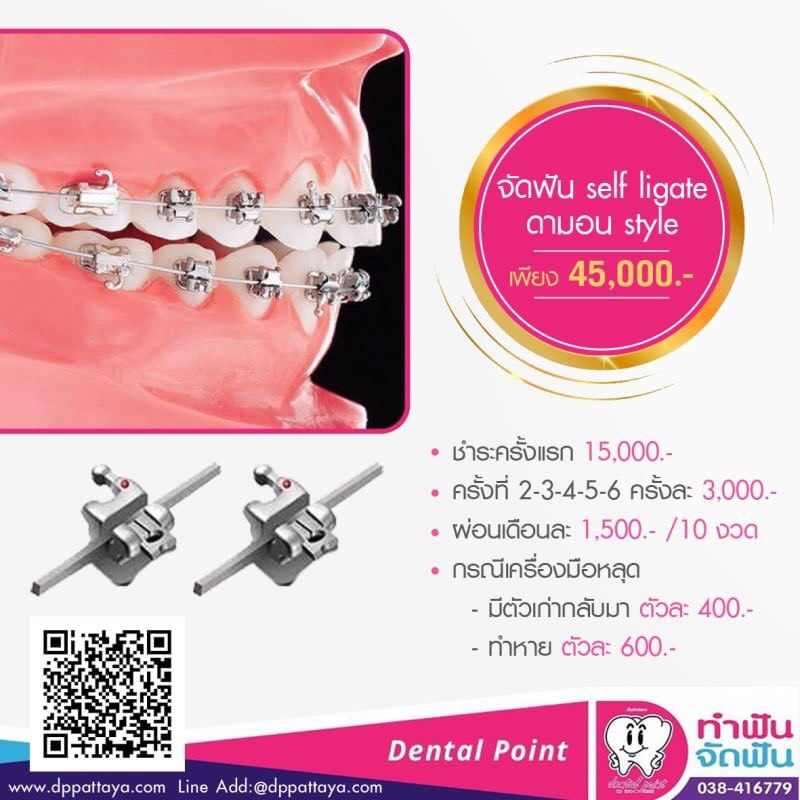 เมนูจัดฟัน self ligate ดามอน style 45,000 จัดฟัน self ligate ดามอน style