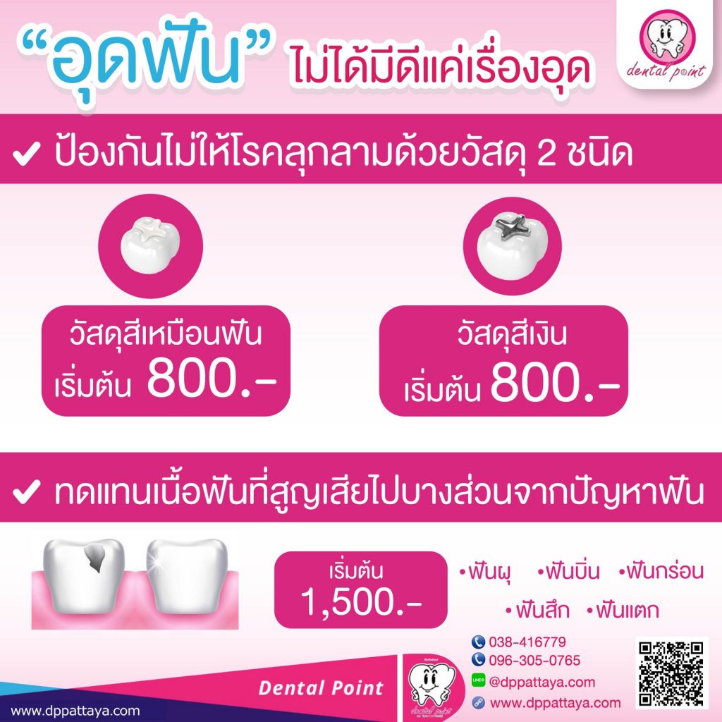 อุดฟันหน้า ราคา