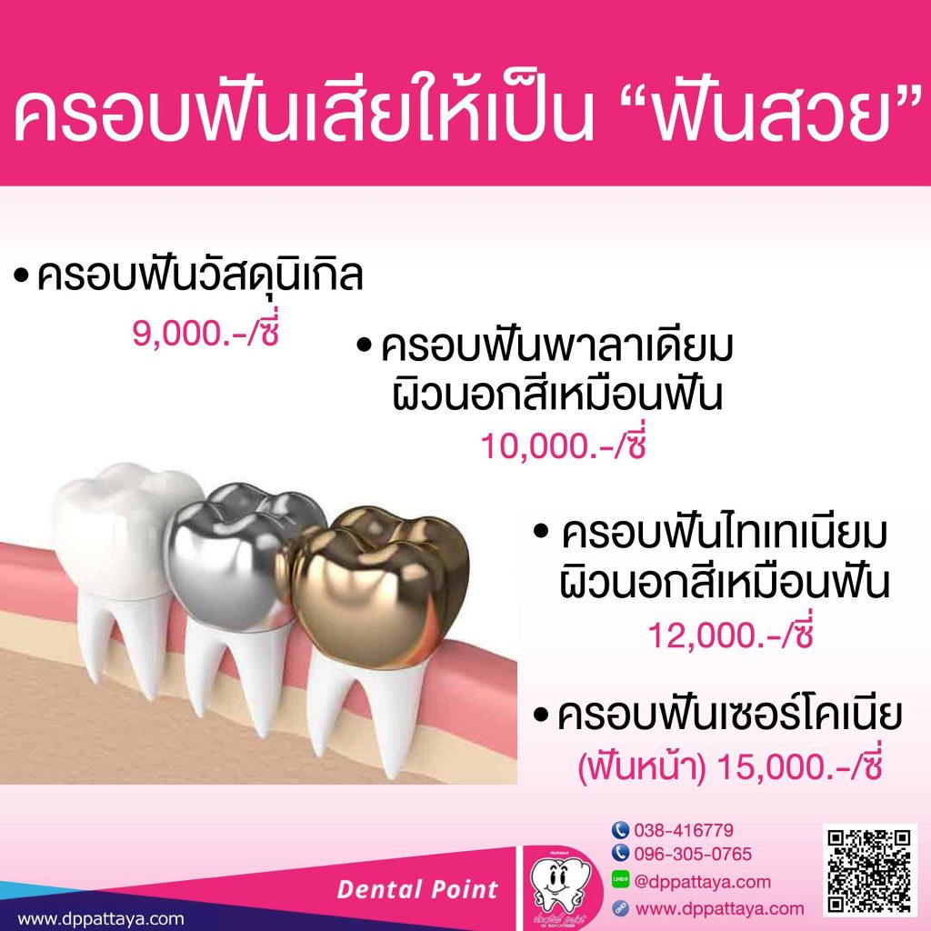 ครอบฟัน ราคา