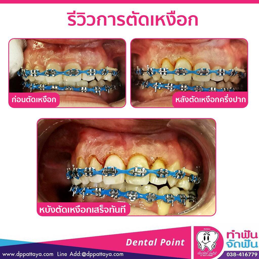 ตัดเหงือก