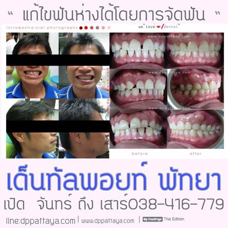 จัดฟันห่าง