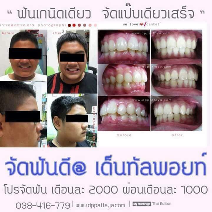 จัดฟันเก