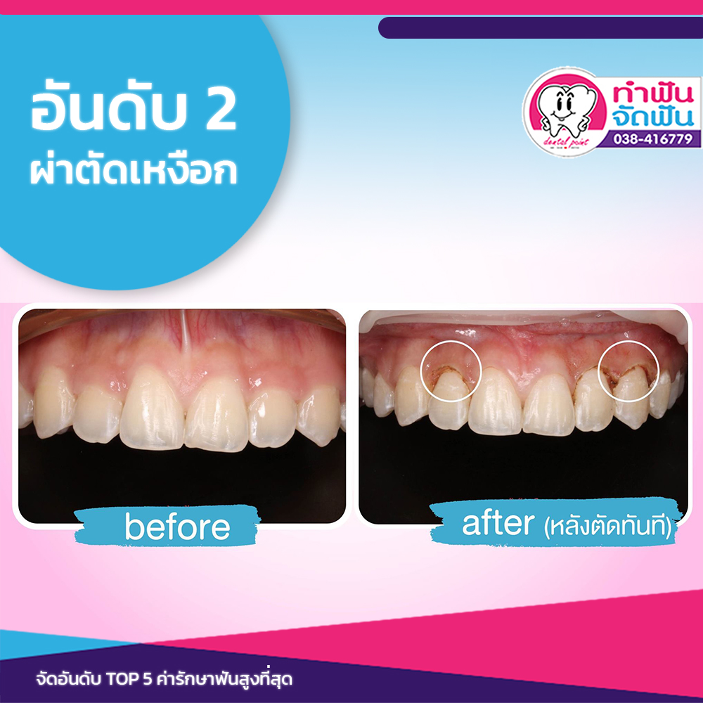 ค่ารักษาฟัน อันดับ 2 ผ่าตัดเหงือก