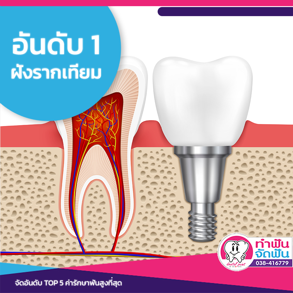 ค่ารักษาฟัน อันดับ 1 : ฝังรากเทียม