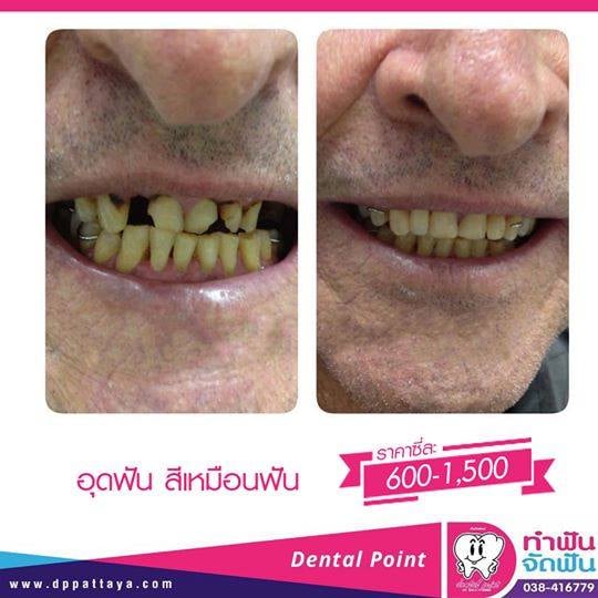 อุดฟัน