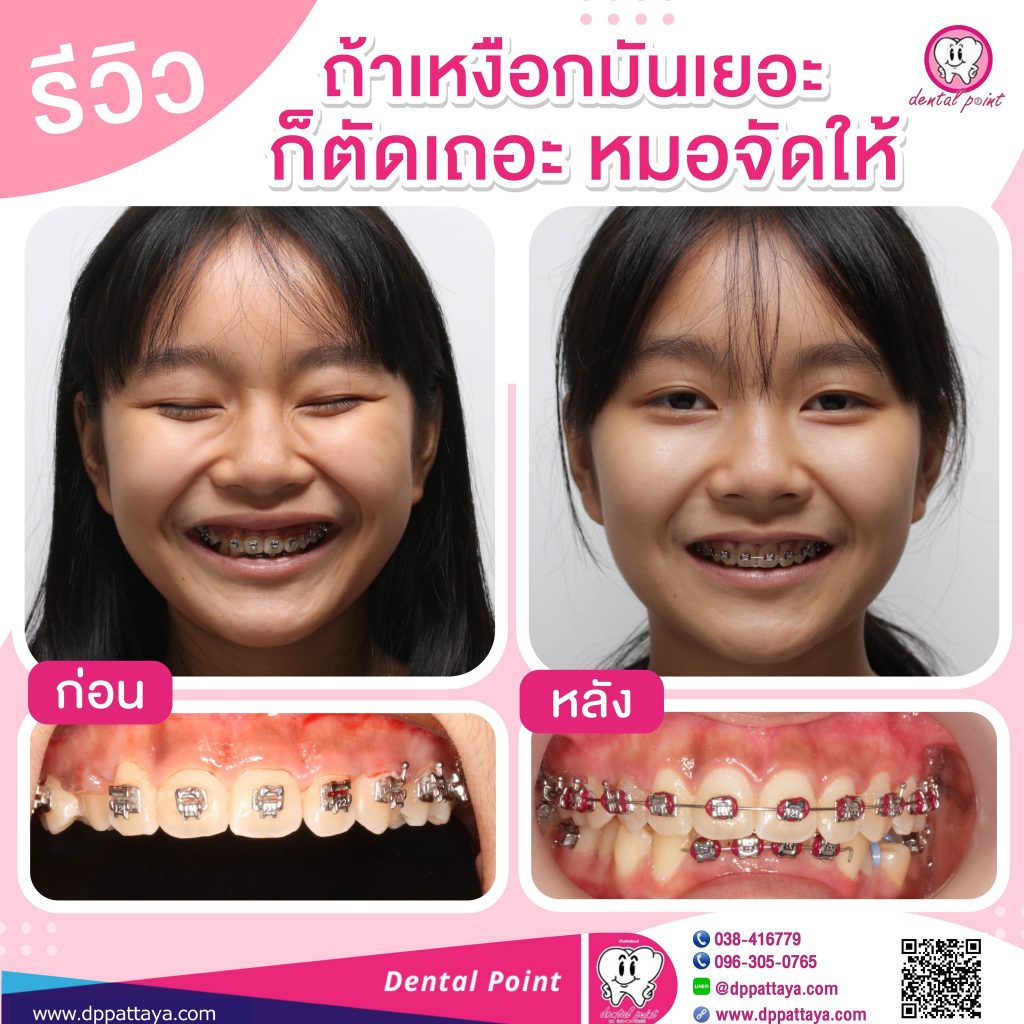 รีวิวตัดเหงือก จัดฟัน
