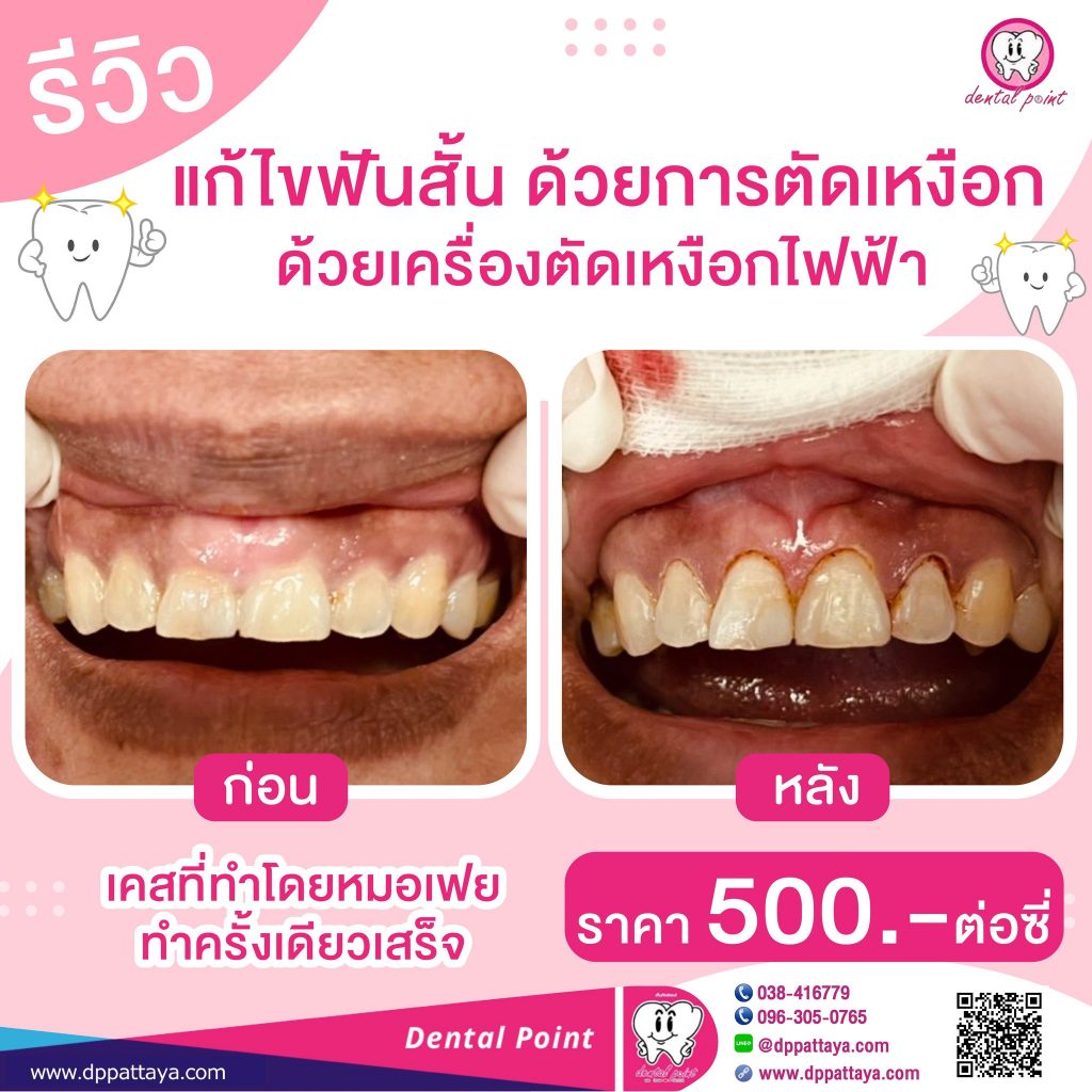 รีวิวตัดเหงือก