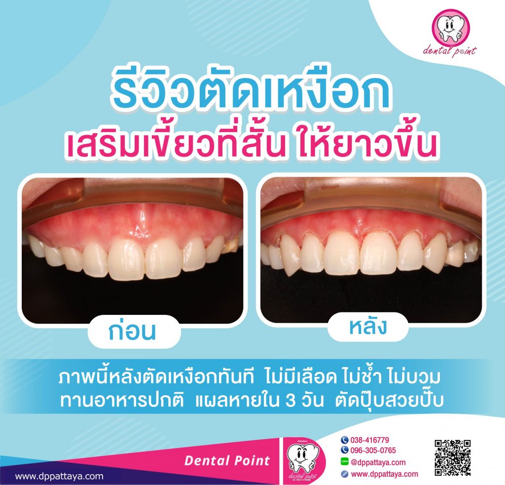 รีวิว ตัดเหงือก