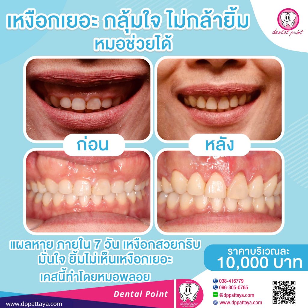 รีวิวตัดเหงือก กรอกระดูก